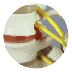 Rygsjle med diskusprolaps - Inkl. stativ - 80 cm.