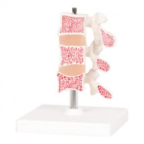 Osteoporose model