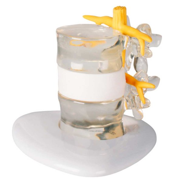 Anatomisk model af diskusprolaps inkl. holder