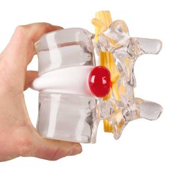 Anatomisk model af diskusprolaps inkl. holder